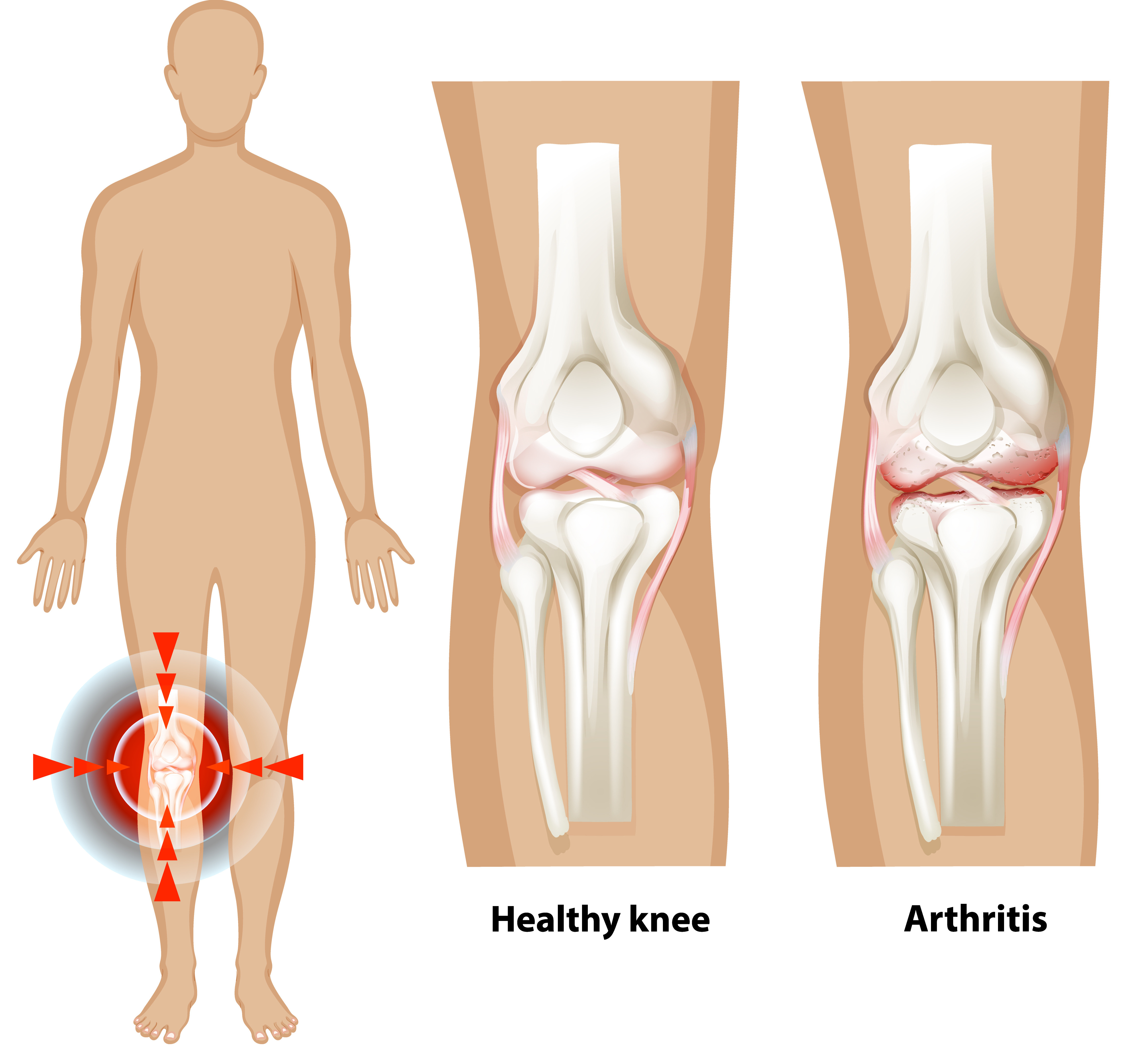 Septic Arthritis