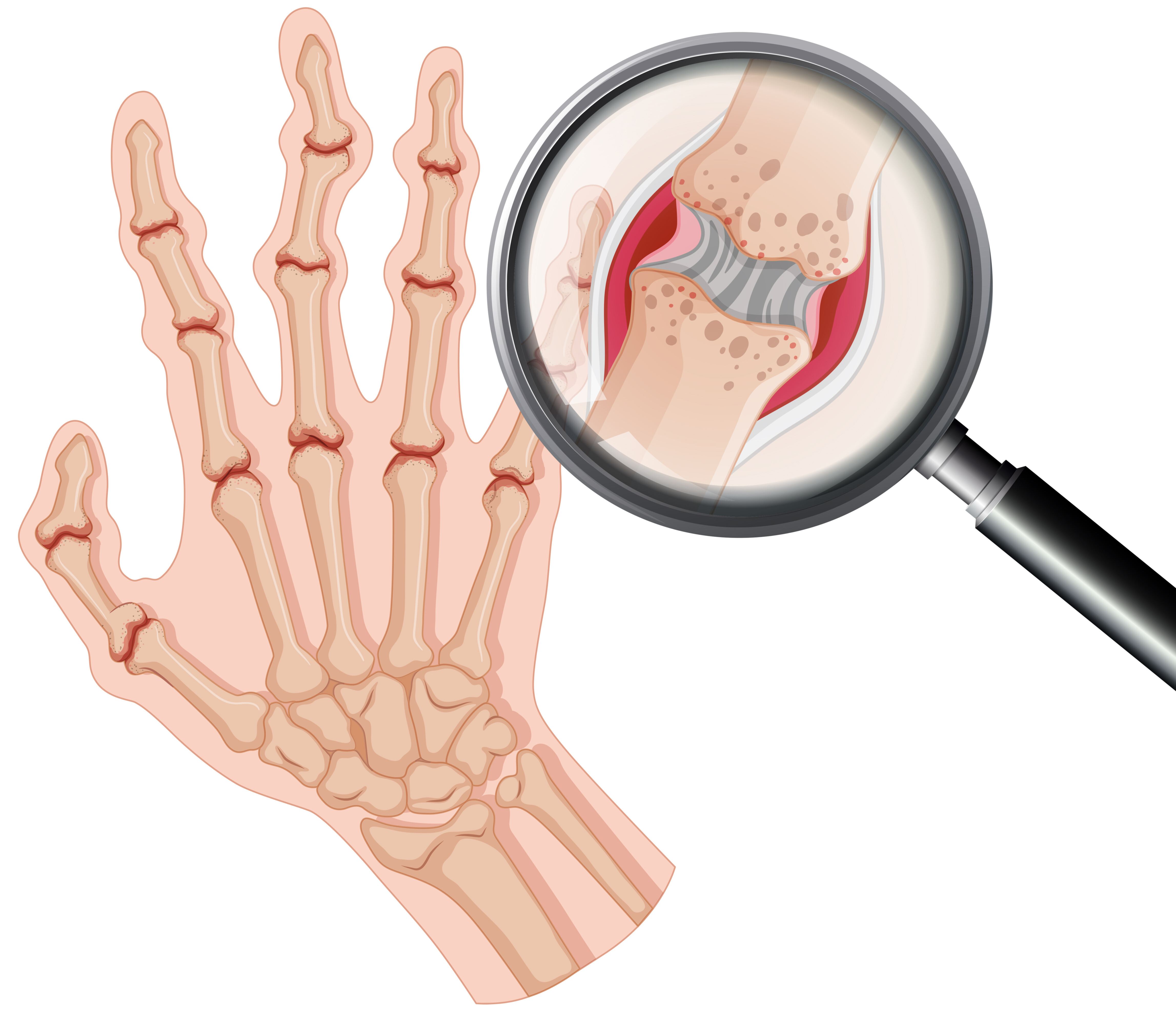 How to Stop Rheumatoid Arthritis Before It Damages Joints
