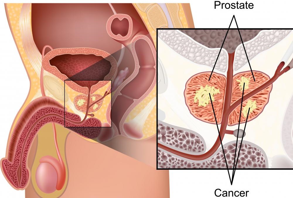 Penis atrophy micro penis
